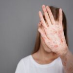 Ιλαρά: 8 κρούσματα στην Ελλάδα – Σύσταση για άμεσο εμβολιασμό (vid)